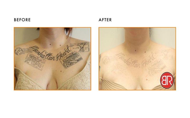 Before & After: Tattoo Removal After 3 Sessions